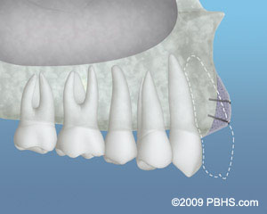 Bone Graft Material Placed