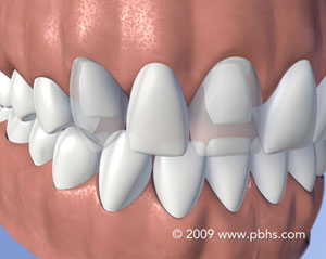 illustration of a dental bridge