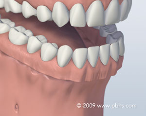 illustration of a Denture