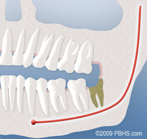 Dry sockets continue to be the most common problem people experience following dental surgery. They arise due to premature loss of a blood clot in the empty tooth socket. This seems to occur with greater frequency in people who smoke or are taking birth control pills. While both jaws can be affected, they usually occur in the lower jaw on the third to fifth day. They cause a deep, dull, continuous aching on the affected side(s). Patients may first notice the pain starting in the ear radiating down towards the chin. The symptoms frequently begin in the middle of the night, and your pain medication regimen may not help. Treatment can involve changing your prescription. Occasionally it is helpful to place a medicated dressing in the empty tooth socket. This will help decrease the pain and protect the socket from food particles. The effectiveness in alleviating the pain lasts for 24-48 hours and may require dressing changes every day or two, for five to seven days. Dressings usually are removed when you have been pain free for 2 to 3 days. The dressing doesn’t aid in healing. The only reason to place a dressing is for pain control. If medication is controlling the pain, the socket will heal without a dressing. Following removal of the dressing, an irrigation device may be provided to help you to keep food particles from lodging in the extraction site.