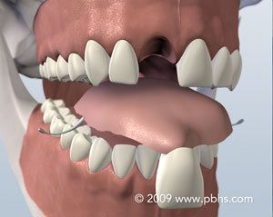 illustration of a Flipper - removable plastic retainer