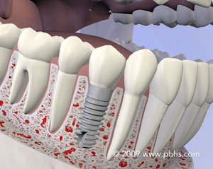 illustration of a Dental Implant