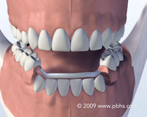 illustration of a removable metal partial denture