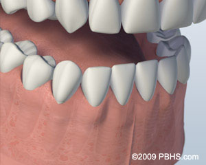 Healing completed after after dental implant