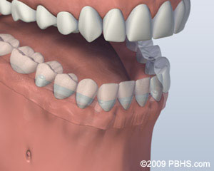 Denture Attached