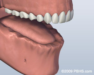 Before Ball Attachment Denture