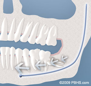 An illustration of teeth crowding causes by a wisdom tooth