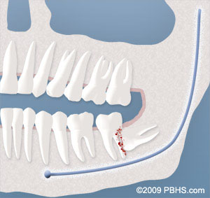 A visual of a wisdom tooth damaging an adjacent tooth