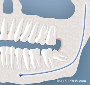 An example of a tooth with a partial bony impaction